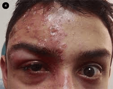 BG is a 24 year male weighing 180 pounds at 5’ 8 was schedule as a regular follow up for the following rash